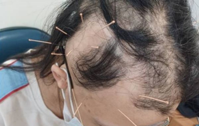 Đột nhiên tóc rụng từng mảng tới "hói trắng cả đầu", nữ sinh bàng hoàng khi nghe bác sĩ tiết lộ nguyên nhân- Ảnh 1.