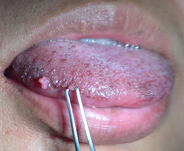 Nam giới tiêm vắc xin HPV thì phòng được những bệnh gì, nên tiêm loại nào?- Ảnh 1.