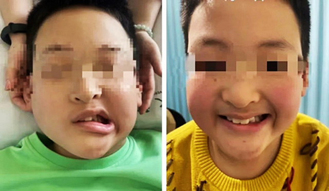 Bé trai 11 tuổi méo miệng do liệt dây thần kinh số VII, bác sĩ cảnh báo nguyên nhân thường gặp- Ảnh 1.