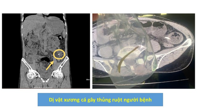 Bất cẩn nuốt thuốc "cả vỏ", người phụ nữ nhập viện vì thủng dạ dày- Ảnh 2.