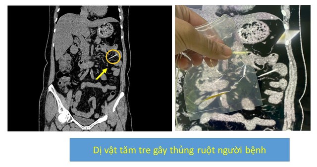Bất cẩn nuốt thuốc "cả vỏ", người phụ nữ nhập viện vì thủng dạ dày- Ảnh 3.