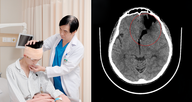 Đau đầu, chảy nước mũi, nam thanh niên phát hiện bị rò dịch não tủy- Ảnh 1.