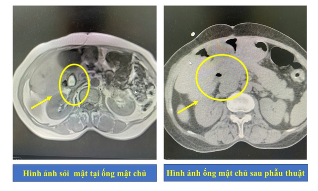 Điều trị bệnh nhân tắc ống mật vì sỏi, bác sĩ phát hiện thêm con giun dài 15cm "quằn quại" bên trong- Ảnh 2.