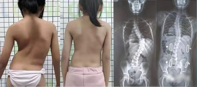 Cột sống của nữ sinh 16 tuổi cong gập 45 độ! Bác sĩ: Cứ 20 trẻ thì có 1 trẻ bị - Ảnh 1. Cột sống của nữ sinh 16 tuổi cong gập 45 độ! Bác sĩ: Cứ 20 trẻ thì có 1 trẻ bị - Ảnh 1.