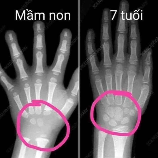 Tràn lan thông tin "trẻ mầm non tập viết sớm hại cho sự phát triển xương": Bác sĩ đính chính- Ảnh 2.