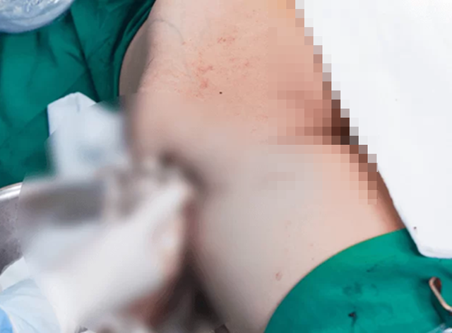 Tiêm 1.000ml filler giả vào mông, cô gái nhập viện hút ra 3.000ml dịch hoại tử- Ảnh 1.
