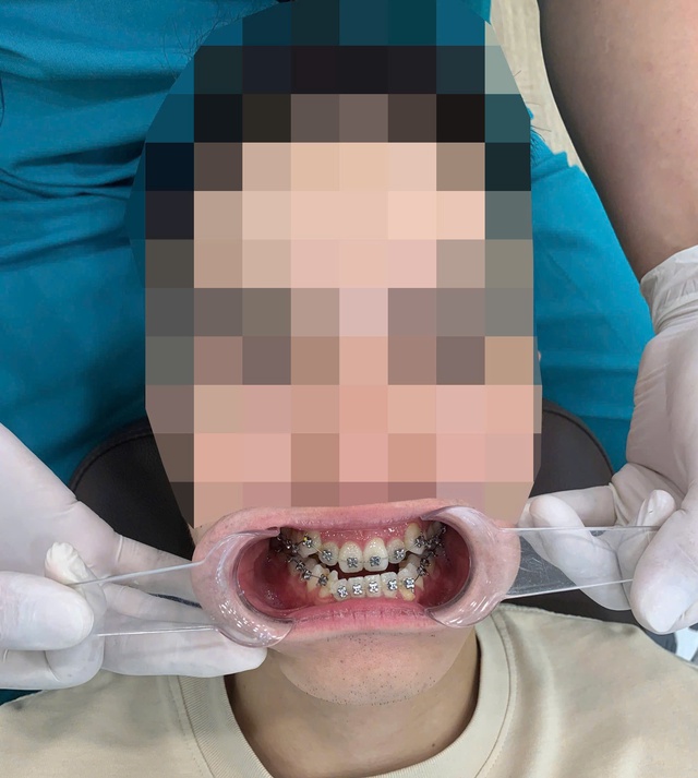 Trầm cảm vì niềng răng 3 năm vẫn "hô như ngày đầu"- Ảnh 2. Trầm cảm vì niềng răng 3 năm vẫn "hô như ngày đầu"- Ảnh 2.
