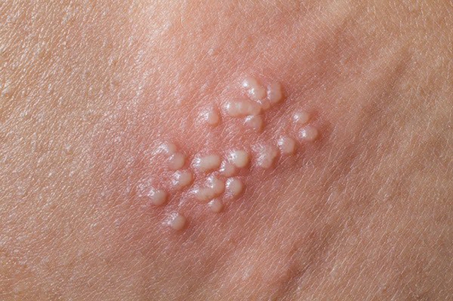 Mụn cóc sinh dục là gì, tiêm vắc xin HPV loại nào mới phòng chống được?- Ảnh 1.