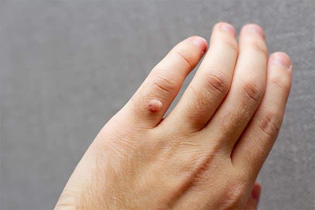 4 loại bệnh ngoài da do nhiễm HPV, tiêm vắc xin HPV liệu có phòng được hết?- Ảnh 1.