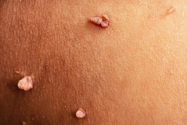 4 loại bệnh ngoài da do nhiễm HPV, tiêm vắc xin HPV liệu có phòng được hết?- Ảnh 2.