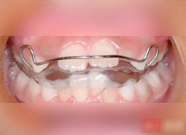 Bé gái 8 tuổi răng hô, môi trên vểnh, cằm nhỏ, trí tuệ giảm vì một thói quen xấu khi ngủ- Ảnh 2.