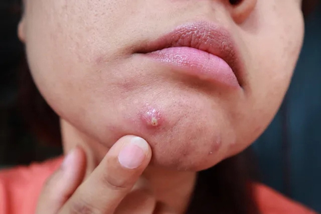 CẢNH BÁO: 4 kiểu mụn rất dễ là "lớp ngụy trang" của bệnh ung thư nhưng ít người để ý- Ảnh 3.