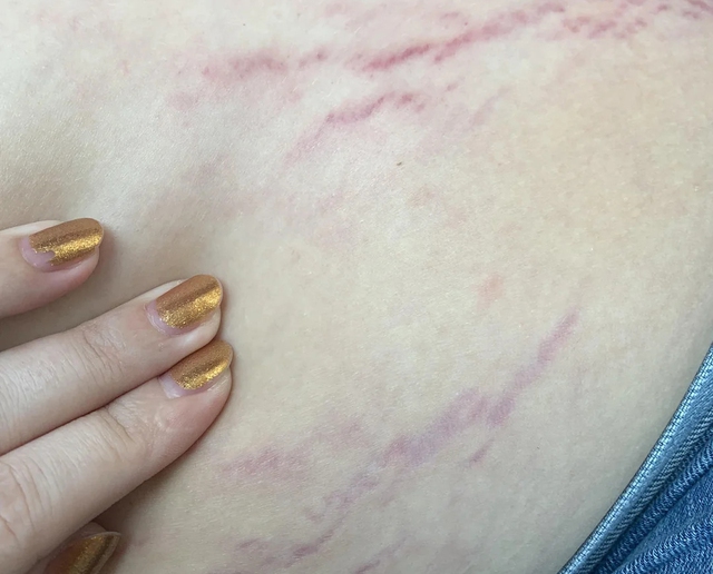 5 thay đổi về ngoại hình là BÁO ĐỘNG bởi ung thư tuyến yên, rất dễ bị nhầm với tăng cân- Ảnh 2.