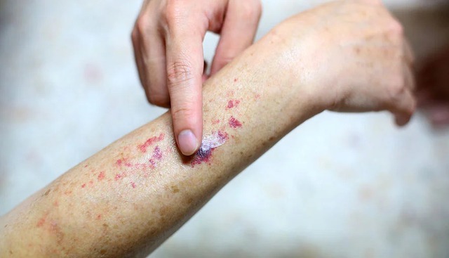 4 thứ này xuất hiện trên da ĐỪNG CHỦ QUAN, e rằng bạn đã mắc ung thư máu!- Ảnh 1.