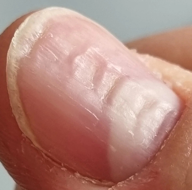 7 bất thường trên móng tay lộ ngay người “giấu” khối u trong cơ thể, kiểm tra xem bạn có không!- Ảnh 3.