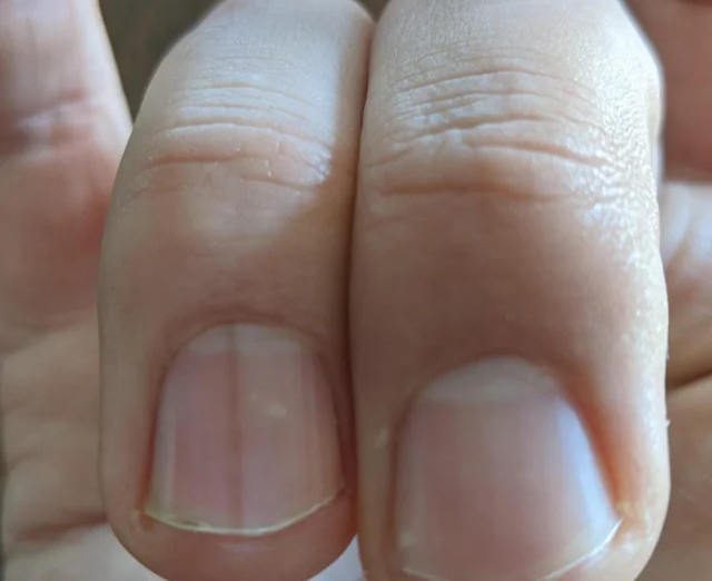 7 bất thường trên móng tay lộ ngay người “giấu” khối u trong cơ thể, kiểm tra xem bạn có không!- Ảnh 1.