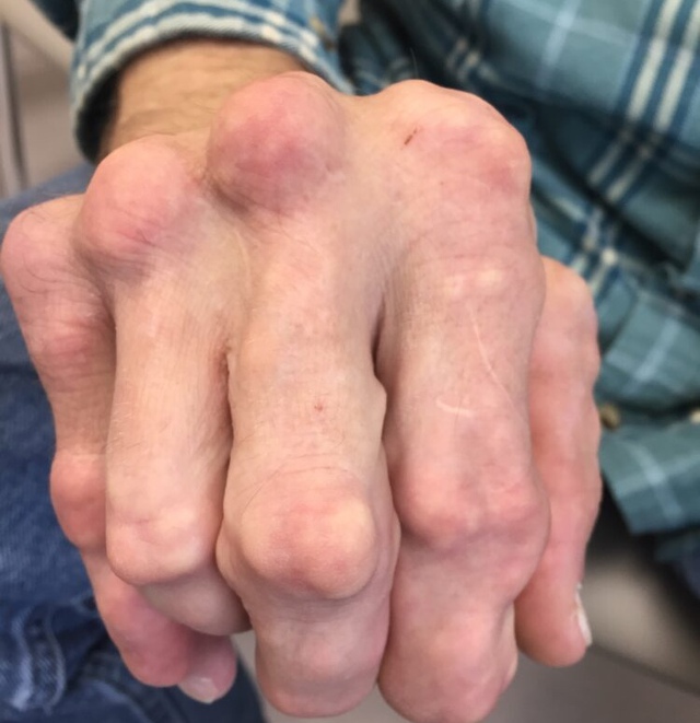 Danh sách đen 6 thực phẩm là "đồng phạm" của bệnh gout nhưng nhiều người ăn vô tội vạ- Ảnh 1.