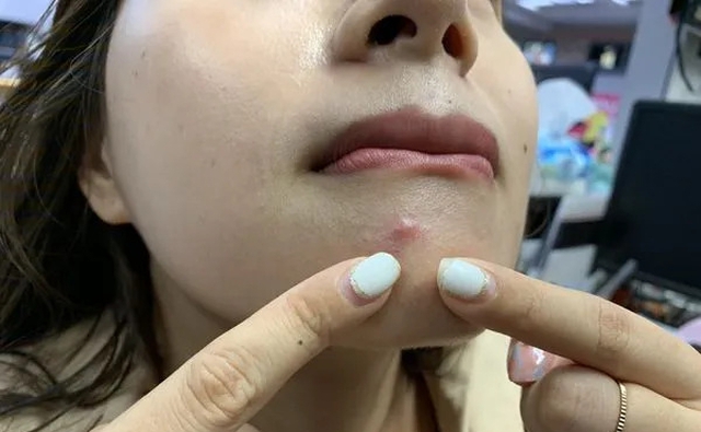 6 vị trí mọc mụn trên mặt ngầm cảnh báo cả tá bệnh: Tim, gan, thận, dạ dày đều đang "kêu cứu"- Ảnh 2.