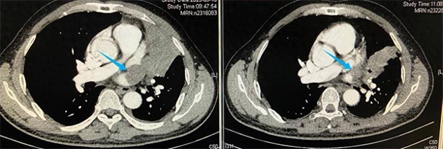Người đàn ông phát hiện ung thư phổi nhờ 1 lần cảm lạnh, một phần trái tim đã bị khối u "ăn" mất- Ảnh 2.