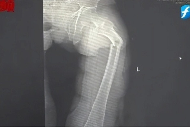 Ngo&agrave;i 30 tuổi xương đ&atilde; "xốp như tổ ong", ho cũng g&atilde;y xương đ&ugrave;i v&igrave; m&ecirc; loại nước "ng&ograve;n ngọt", uống t&ecirc; đầu lưỡi- Ảnh 2.