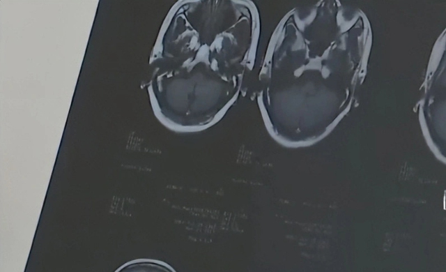 Học sinh lớp 6 đột quỵ d&ugrave; chăm vận động, b&aacute;c sĩ hốt hoảng: Trời lạnh mấy cũng ĐỪNG QU&Ecirc;N l&agrave;m 1 việc!- Ảnh 2.