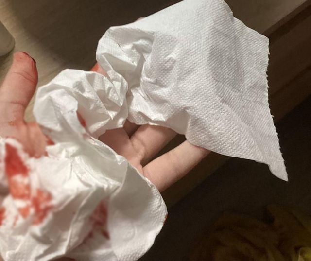 Nữ thư ký ngất xỉu khi đi vệ sinh, tưởng đột quỵ hóa ra suýt chết vì Nữ thư ký ngất xỉu khi đi vệ sinh, tưởng đột quỵ hóa ra suýt chết vì