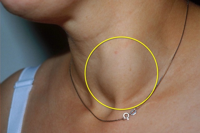 8 người một nh&agrave; c&ugrave;ng mắc ung thư tuyến gi&aacute;p, b&aacute;c sĩ nhắc nhở: Thấy 5 thay đổi n&agrave;y, e rằng "tế b&agrave;o ung thư" đ&atilde; lớn- Ảnh 2.