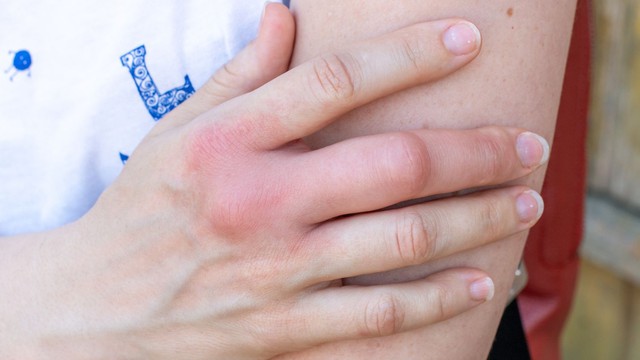 6 bất thường ở ngón tay cảnh báo nhiều bệnh nặng, đặc biệt là ung thư! - Ảnh 3.