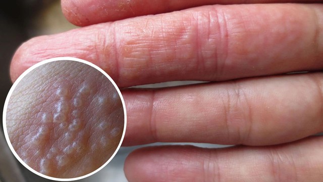 6 bất thường ở ngón tay cảnh báo nhiều bệnh nặng, đặc biệt là ung thư! - Ảnh 4.