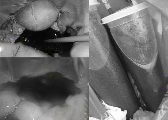 C&ocirc; g&aacute;i trẻ cấp cứu giữa đ&ecirc;m valentine, chảy tới 1,5 l&iacute;t m&aacute;u v&igrave; 1 việc c&aacute;c cặp đ&ocirc;i trẻ rất th&iacute;ch khi l&agrave;m "chuyện ấy"- Ảnh 2.