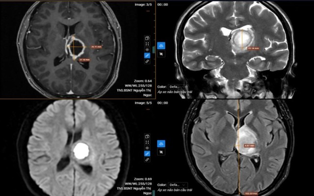 Thường xuy&ecirc;n buồn ngủ, đi kh&aacute;m &ldquo;sốc&rdquo; nặng khi biết nguy&ecirc;n nh&acirc;n- Ảnh 1.
