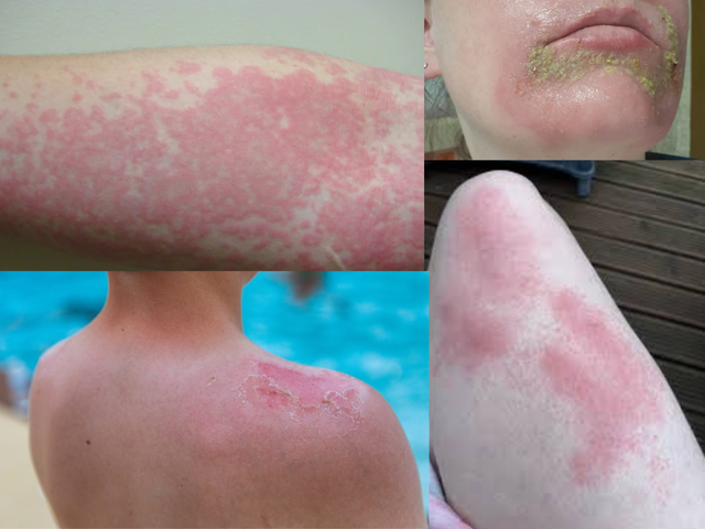 Nước tiểu m&agrave;u đỏ v&agrave; n&ocirc;n ra chất lỏng m&agrave;u đen, c&ocirc; g&aacute;i 25 tuổi b&agrave;ng ho&agrave;ng khi b&aacute;c sĩ n&oacute;i: Bệnh "ma c&agrave; rồng", kh&ocirc;ng chữa được!- Ảnh 2.