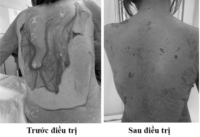 Hải Ph&ograve;ng: 1 phụ nữ 35 tuổi bị tr&oacute;c da như "cua lột" v&igrave; th&oacute;i quen d&ugrave;ng thuốc cực kỳ phổ biến - Ảnh 1.