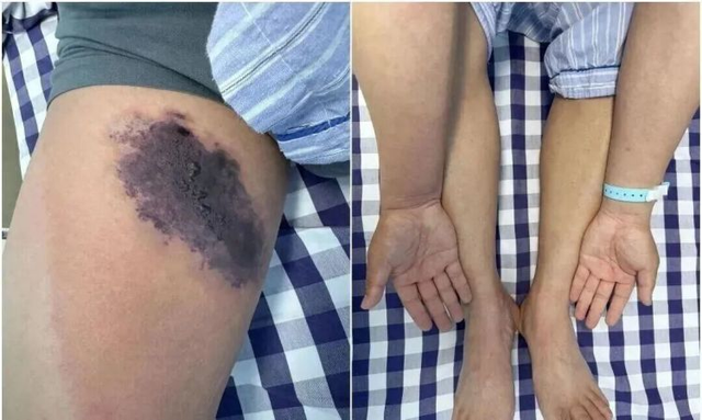 Mặc chiếc quần cũ, người đàn ông suýt "nhiễm độc toàn thân"- Ảnh 1. Mặc chiếc quần cũ, người đàn ông suýt "nhiễm độc toàn thân"- Ảnh 1.