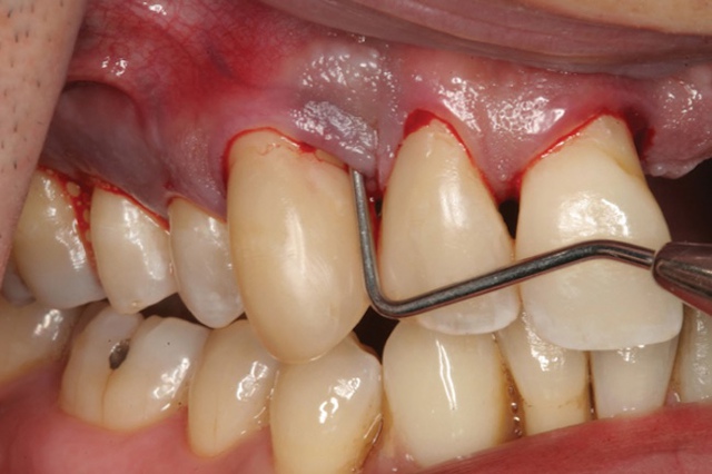 Người đ&agrave;n &ocirc;ng 51 tuổi khổ sở v&igrave; "khối u" tim lỗ chỗ như tổ ong bắp c&agrave;y, b&aacute;c sĩ tức giận: Bệnh từ miệng m&agrave; ra! - Ảnh 3.