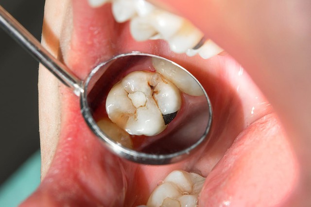 Chảy m&aacute;u lợi khi đ&aacute;nh răng g&acirc;y nguy hiểm cho n&atilde;o! C&aacute;c b&aacute;c sĩ cảnh b&aacute;o: 2 vấn đề răng miệng tăng gấp đ&ocirc;i nguy cơ đột quỵ - Ảnh 2.