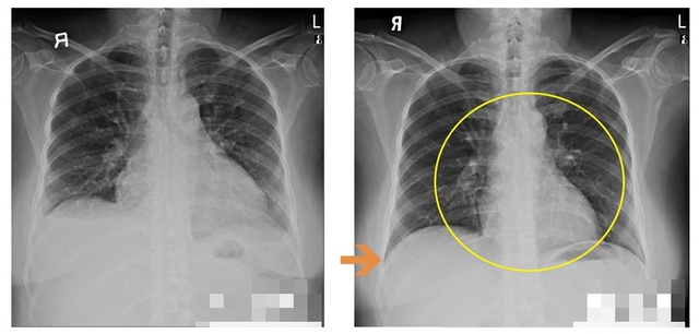 Người phụ nữ 50 tuổi kh&ocirc;ng uống rượu hay h&uacute;t thuốc, ho suốt 1 th&aacute;ng: Đi kh&aacute;m ph&aacute;t hiện thứ g&acirc;y sốc ở tim - Ảnh 2.