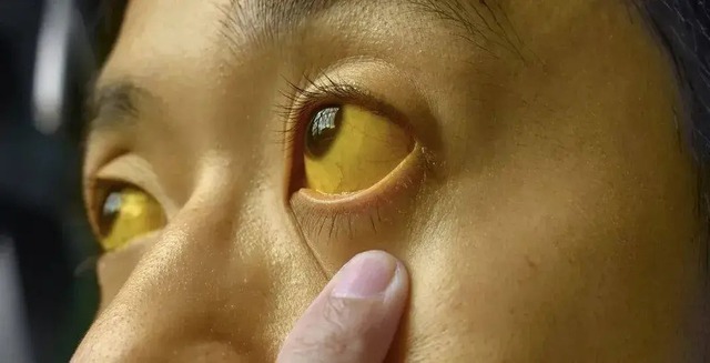Nếu mắt c&oacute; 6 thứ, đi kh&aacute;m ung thư ngay c&ograve;n kịp! - Ảnh 2.