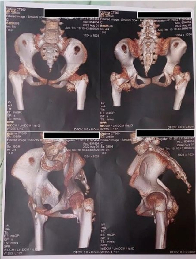 B&eacute; g&aacute;i 12 tuổi mắc "hội chứng người h&oacute;a đ&aacute; hiếm gặp", bố mẹ ngỡ ng&agrave;ng khi b&aacute;c sĩ nhắc tới c&uacute; ng&atilde; xe đạp 2 năm trước - Ảnh 2.