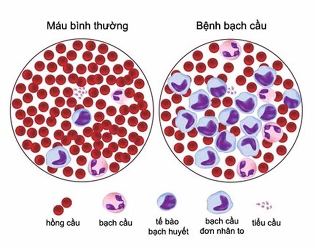 Nam công nhân bị bạch cầu cấp tính, suýt mất mạng vì xem nhẹ kiểu "ốm vặt" dễ gặp mùa hè - Ảnh 2.