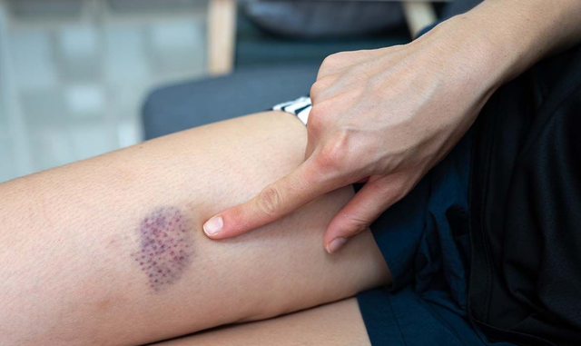 Nam công nhân bị bạch cầu cấp tính, suýt mất mạng vì xem nhẹ kiểu "ốm vặt" dễ gặp mùa hè - Ảnh 3.