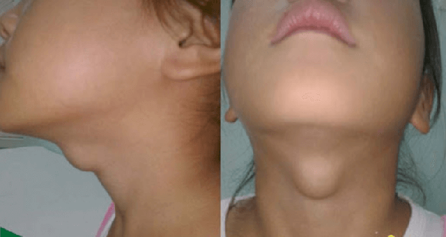 Một nhà 3 người cùng mắc ung thư tuyến giáp: "Thủ phạm" là món rau nhiều người tưởng ăn càng nhiều càng khỏe- Ảnh 3.