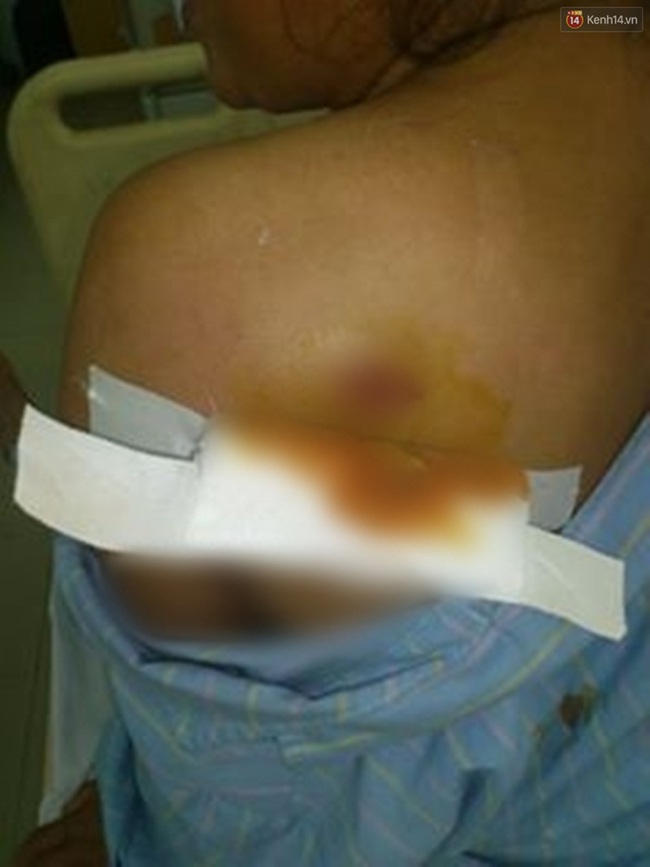 Một phụ nữ ở Nghệ An bị 2 thanh niên dùng súng tự chế bắn vào lưng - Ảnh 1.