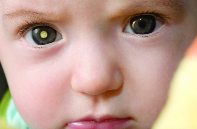 Tìm hiểu căn bệnh ung thư quái ác khiến đôi mắt trẻ con lấp lánh như kim cương - Ảnh 2.