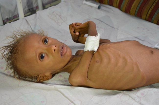 Những thân hình chỉ còn da bọc xương gây sốc: Cả một thế hệ của Yemen đang đứng trước nguy cơ diệt vong vì nạn - Ảnh 1.