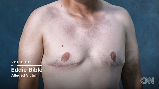 Mỹ: Hàng ngàn nam giới có ngực bự bất thường do sử dụng thuốc an thần - Ảnh 2.
