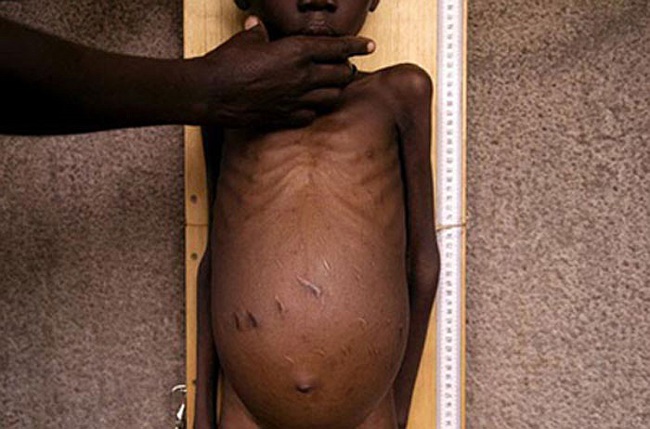 Chùm ảnh những đứa trẻ châu Phi gầy trơ xương vì đói sẽ khiến bạn không dám bỏ thừa đồ ăn thêm nữa - Ảnh 13.