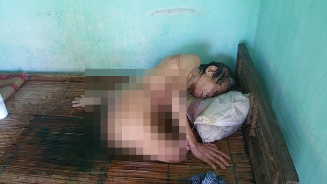 Cộng đồng k&ecirc;u gọi gi&uacute;p đỡ cụ b&agrave; m&ugrave;, cụt ch&acirc;n đang thoi th&oacute;p v&igrave; vết thương lở lo&eacute;t - Ảnh 2.
