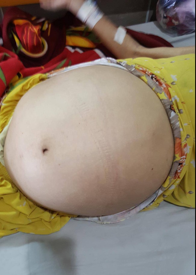 Người phụ nữ mang khối u nặng 12kg trong bụng như mang bầu suốt nhiều năm - Ảnh 1.
