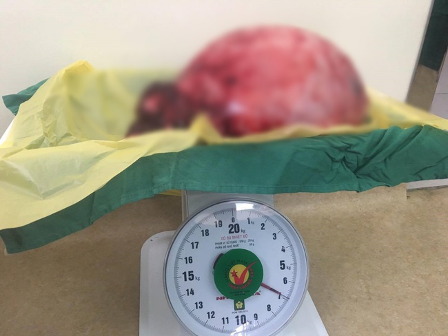 Người phụ nữ mang khối u nặng 12kg trong bụng như mang bầu suốt nhiều năm - Ảnh 2.